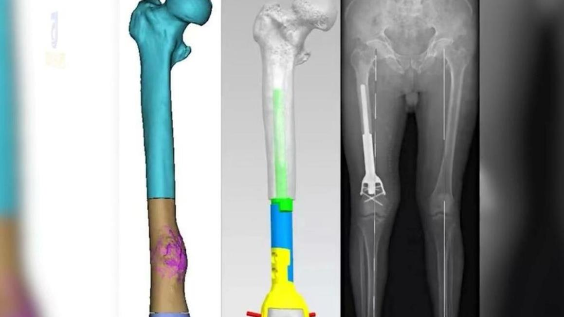 3Dプリンターでつくった「人工の骨」移植に成功する